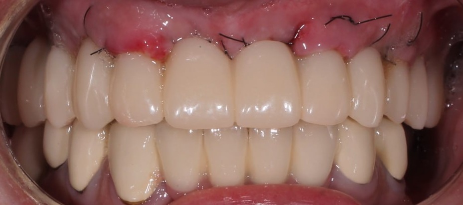 После фиксации временного адаптационного протеза