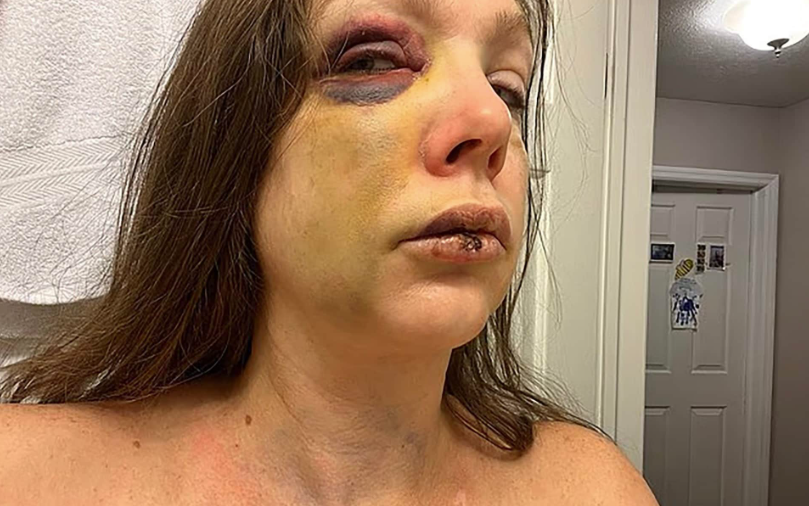 Травмы, полученные женщиной после нападения во время массовой драки в Цинциннати © x.com/berniemoreno