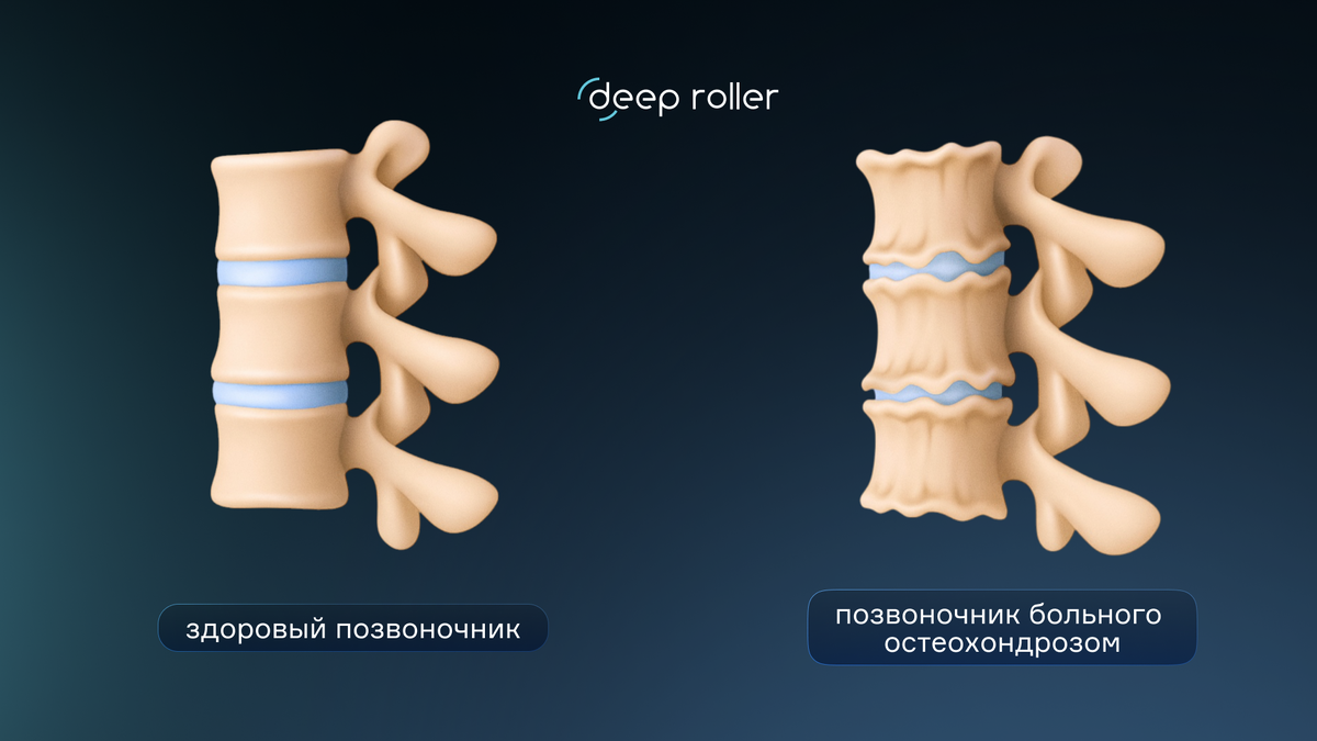 Как выглядит здоровый позвоночник и позвоночник при остеохондрозе