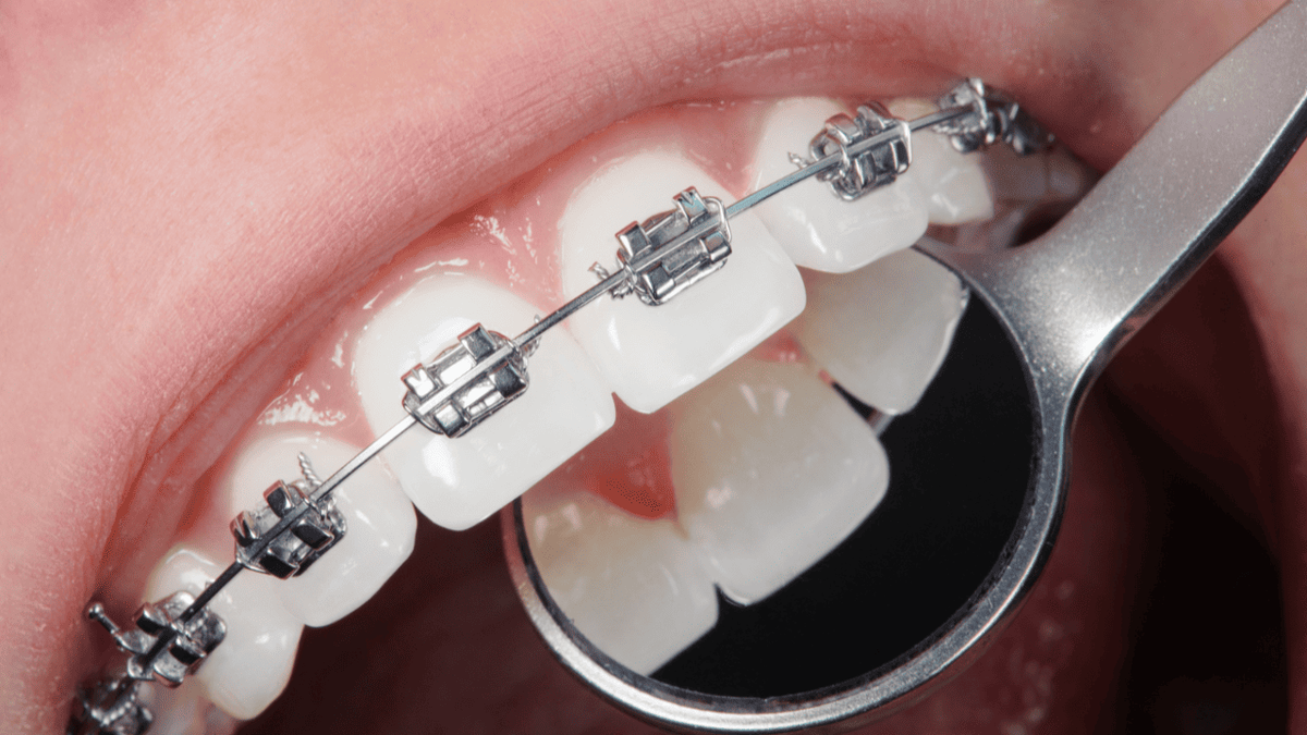Как ставят брекеты: честный гайд без страшилок + актуальные цены и лайфхаки