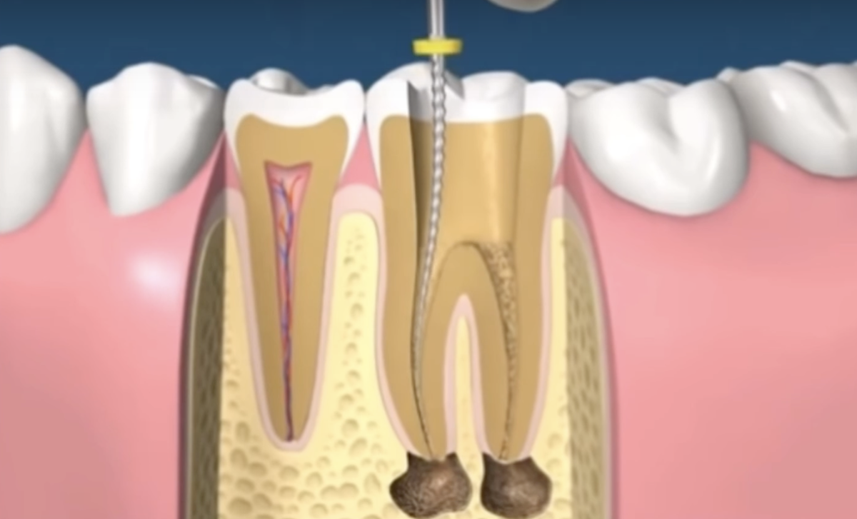 Лечение корневых каналов