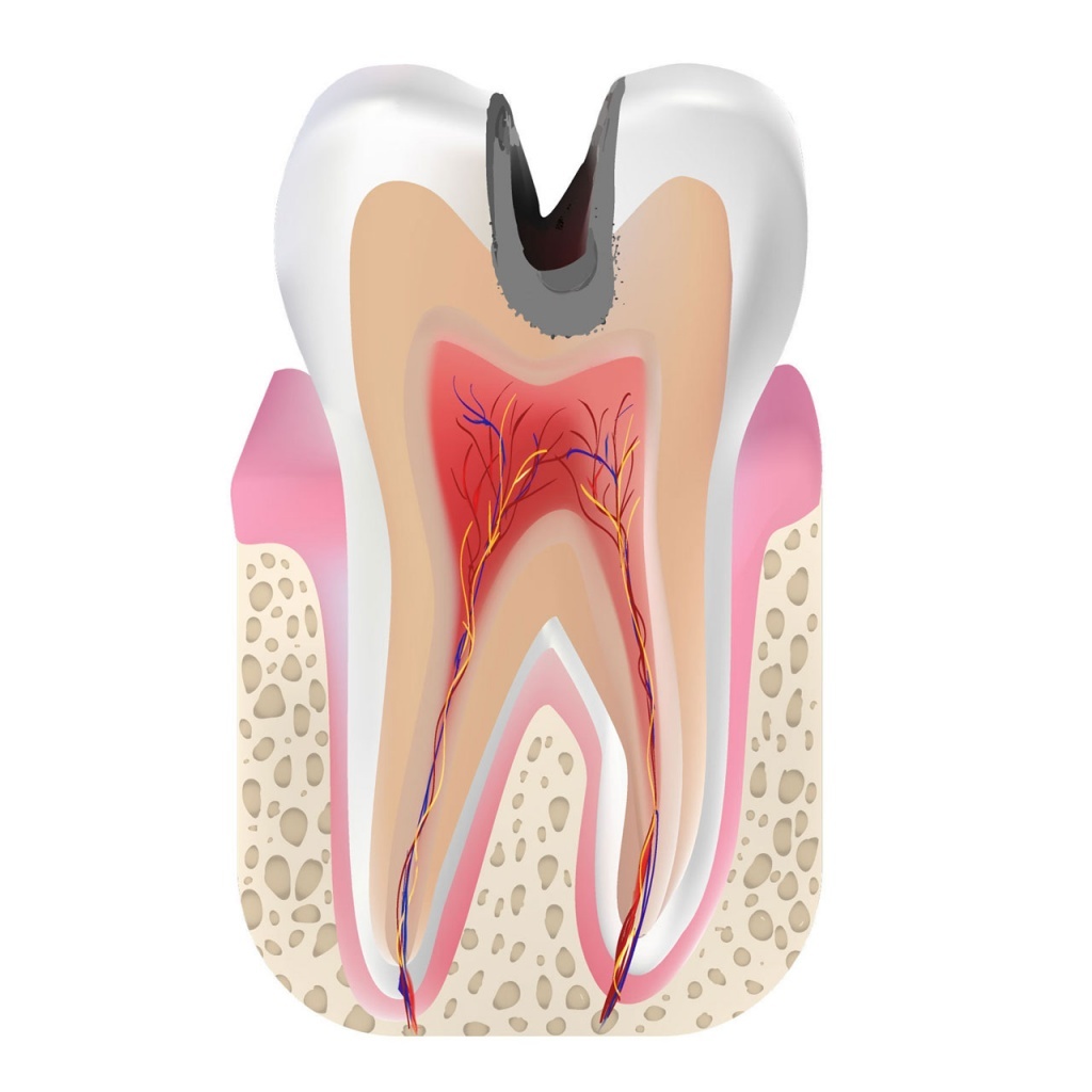 Глубокий кариес в дентине