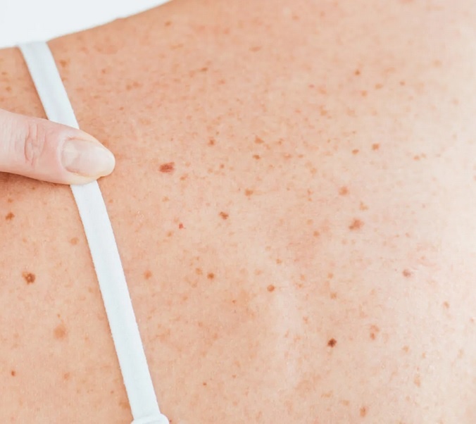 Опасная форма родинки