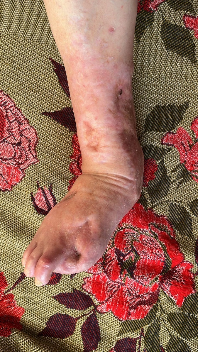 Состояние ноги после проведения лечения через 3 года - фотоархив пациента. Листайте вправо.