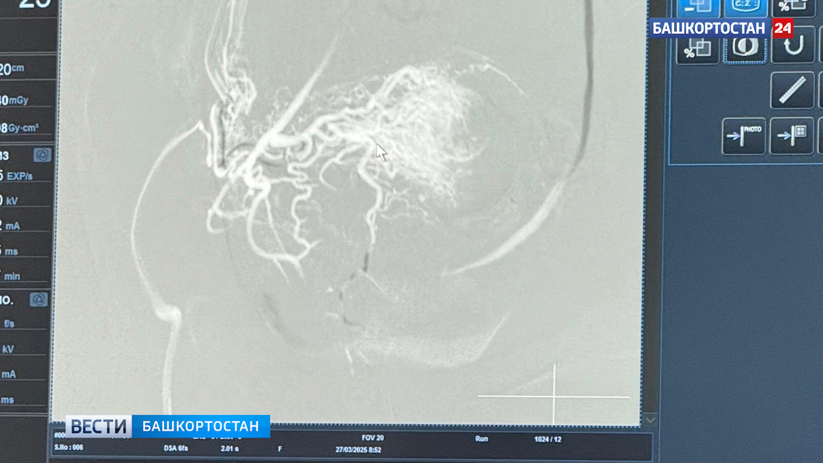    Ради спасения жизни беременной уфимским врачам пришлось удалить эмбрион