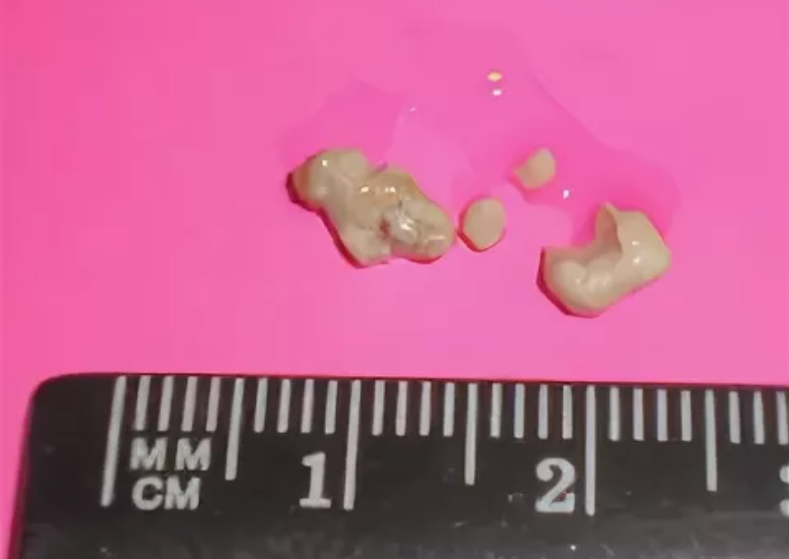 Дакриолиты. 