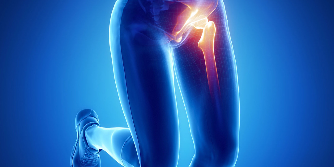 Коксартроз тазобедренного сустава