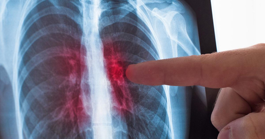 Тревожные сигналы на руках: как заподозрить рак лёгких до появления кашля?