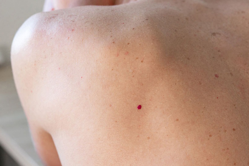    Ангиомы на теле: что это такое и почему появляются