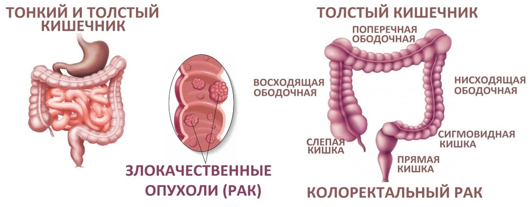 Рак кишечника на ранней стадии: 4 тревожных сигнала