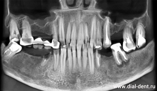КТ зубов до лечения