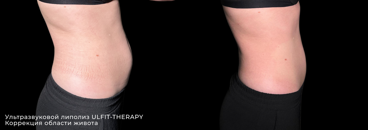 Фото до и после ультразвукового липолиза Ulfit в клинике косметологии GEN87