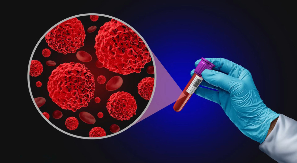 Рак Крови: 4 Признака, Которые Можно Заметить Самому — Не Игнорируйте Эти Симптомы