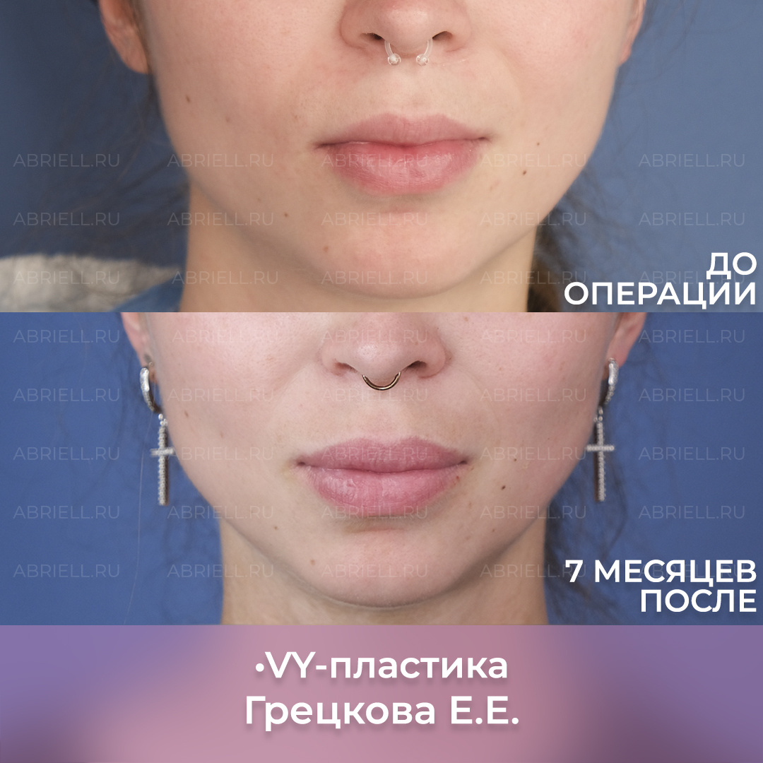 Увеличение губ методов VY-пластика. Хейлопластика результат до и после. Пластический хирург в Санкт-Петербурге Грецкова Евгения Евгеньевна в клинике Абриелль