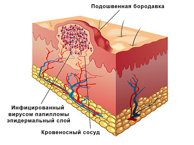 Бородавка, строение