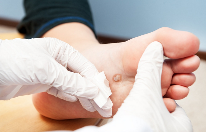 Подошвенная бородавка