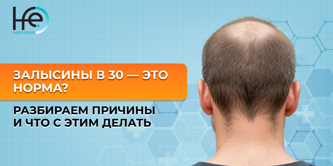 Залысины в 30 — это норма? Разбираем причины и что с этим делать