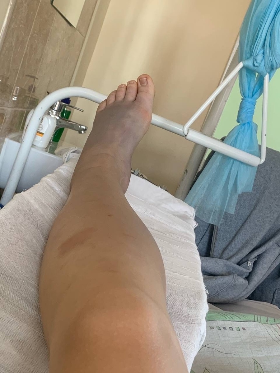    Последствия укуса гадюки. Фото: Светлана Фруцкая