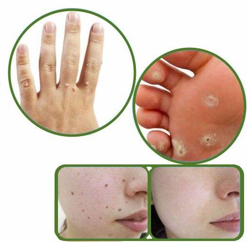 рис. 1а. Доброкачественные образования кожи (вирусные бородавки, родинки). рис. 1б. Дерматоскопия образований кожи. 