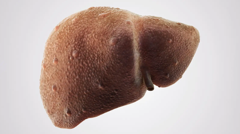     Фиброз печени развивается на фоне хронического воспаления и не сопровождается специфическими симптомами. Фото: Flickr