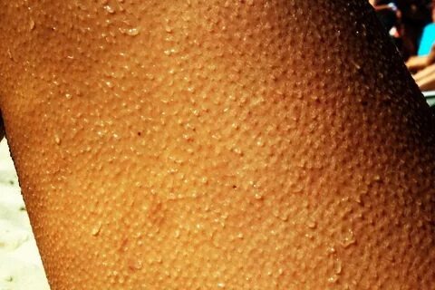 Реакция на музыку, холод или сильные эмоции — мурашки всегда говорят о чём-то важном