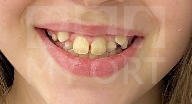 Улыбка пациентки до лечения