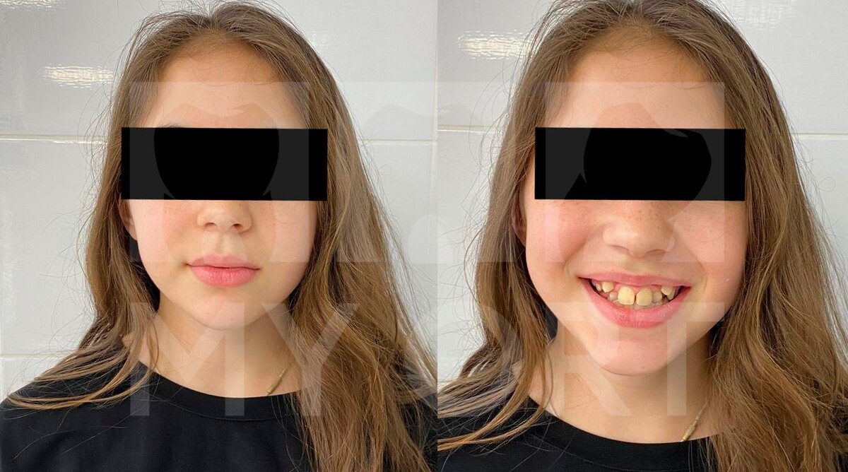 Улыбка пациентки до лечения