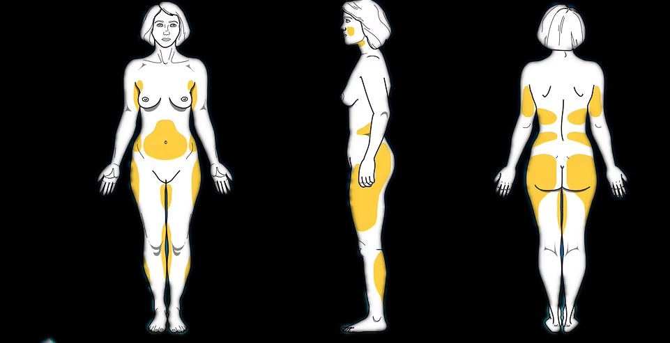 Области, на которые распространяются жировые ловушки