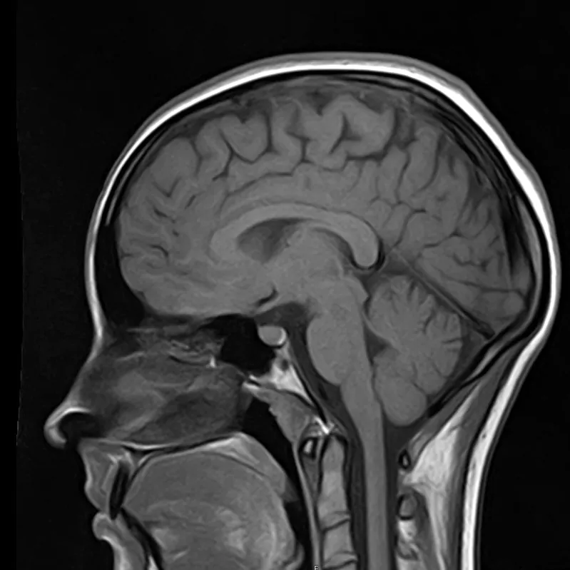                                                                  Головная боль на МРТ