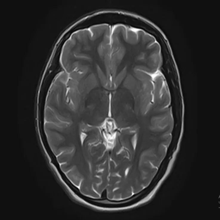                                                               Головная боль на МРТ