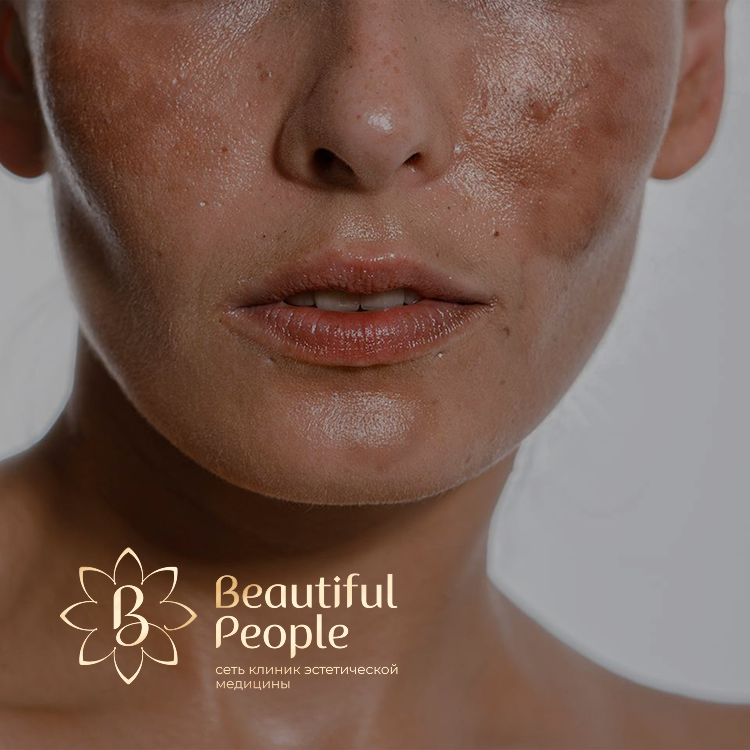 Профессиональная коррекция пигментных пятен от солнца