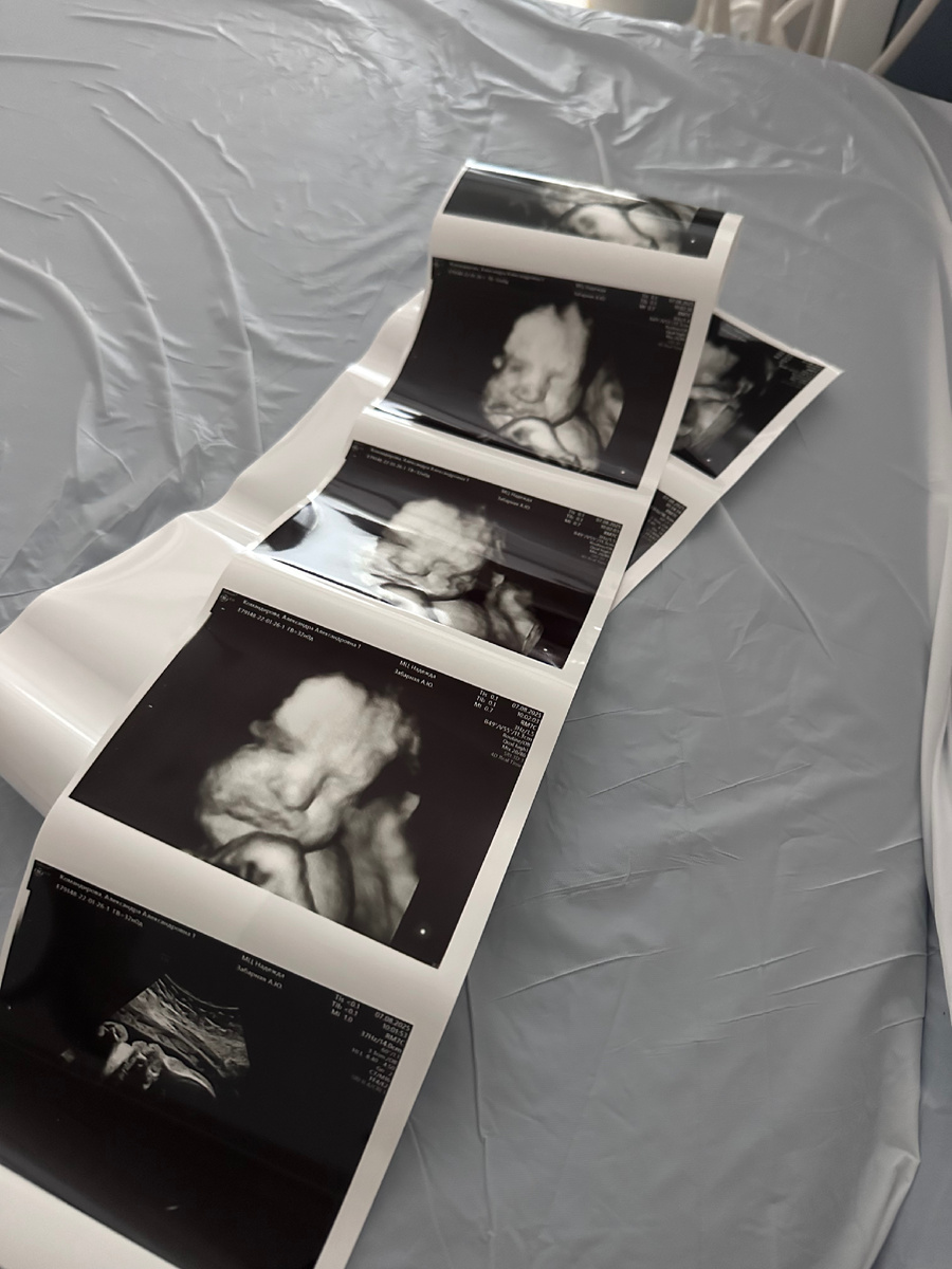 УЗИ 32 недели