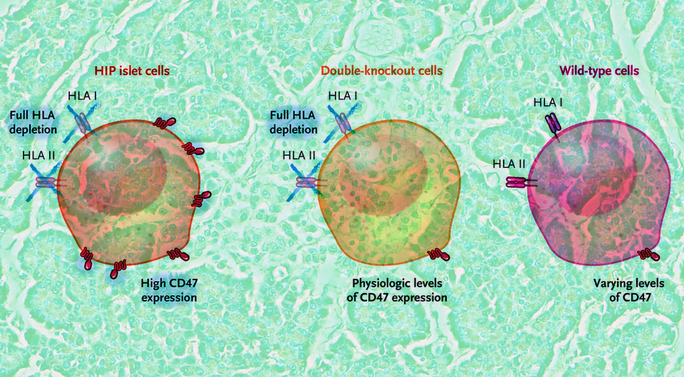   N + 1; Berkshire Community College Bioscience Image Library / Flickr / Public domain; Per-Ola Carlsson et al. / NEJM, 2025