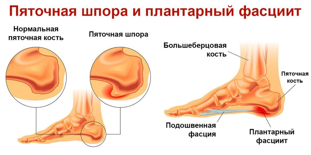 Пяточная шпора: симптомы, диагностика, лечение и профилактика