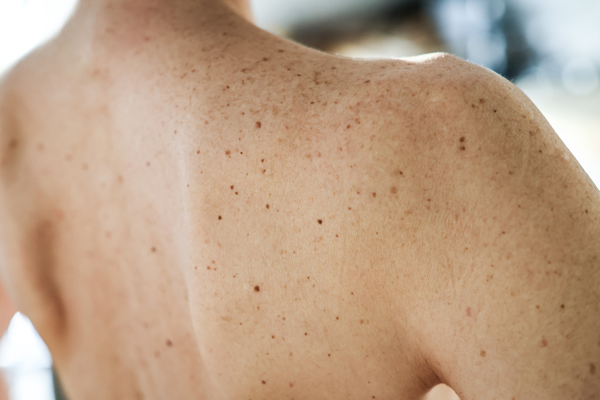     Почему у некоторых людей так много родинок?