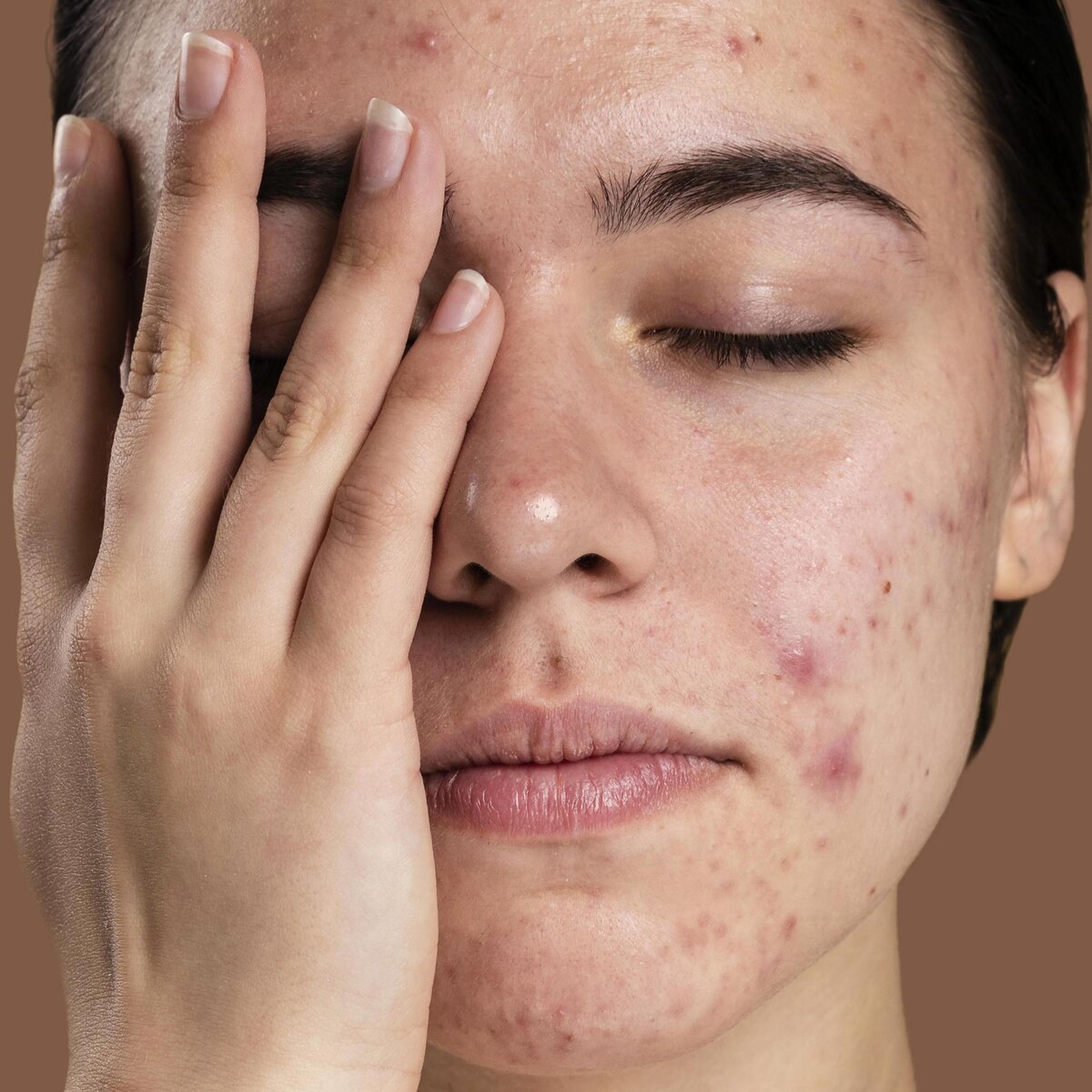 Накопившиеся токсины в организме проявляются на коже в виде высыпаний