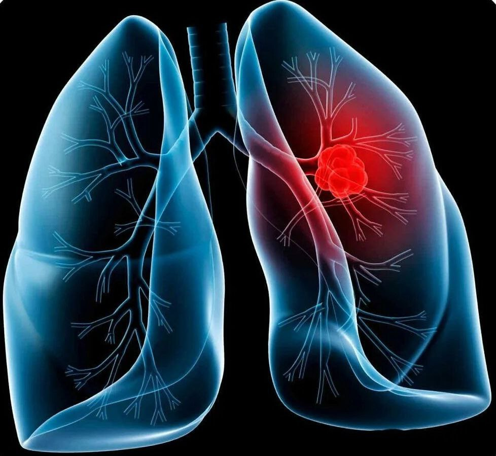 До появоееия пепвыз симтомов обнаружить рак лёгкого ещё недавно было крацне сложно. Фото: onkoamur.ruФото: 