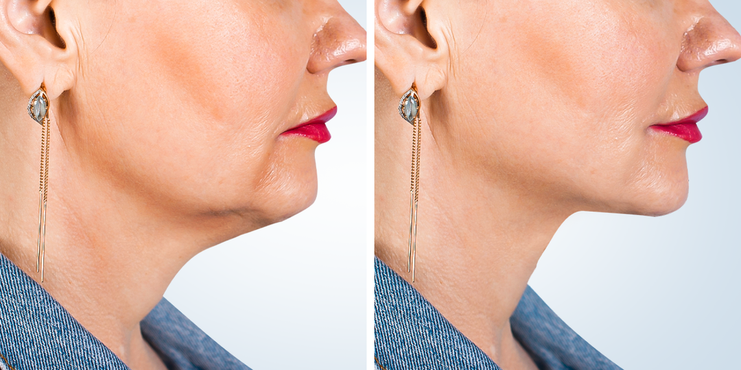 Щеки и правда подтягиваются, если не совершать главной ошибки - 7 минут для молодого овала