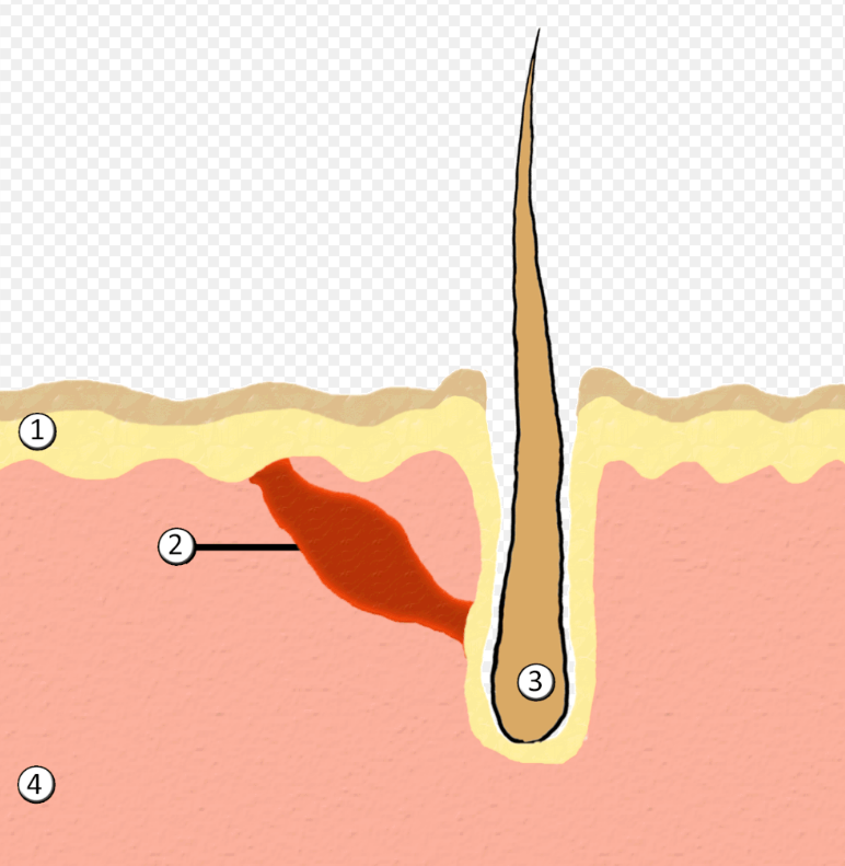    1. Эпидермис, 2. Мускул, поднимающий волосок, 3. Волосяной фолликул, 4. ДермаWikipedia