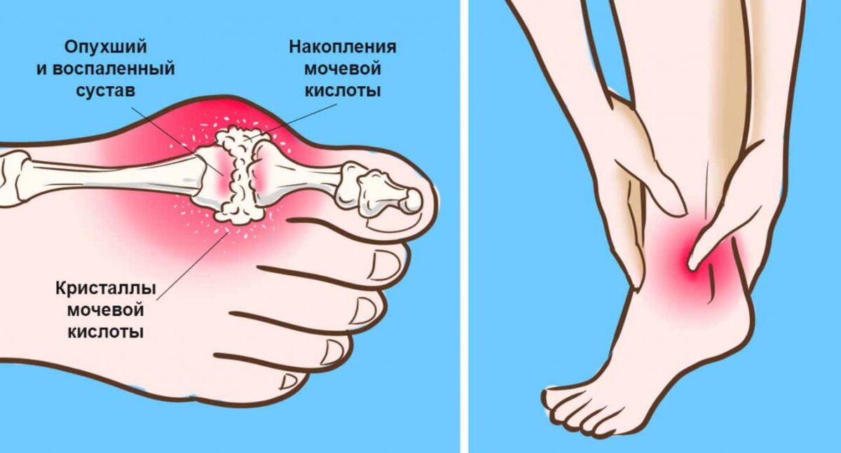 Мочевая Кислота: Что Это и Как Её Уровень Влияет на Суставы