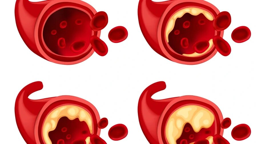 На картинке изображен здоровый сосуд (1) и пораженные атеросклеротическими бляшками. 