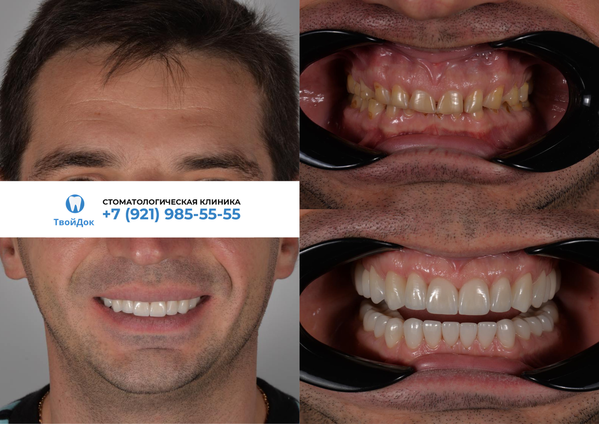 Полная реконструкция при генерализованной стираемости зубов.