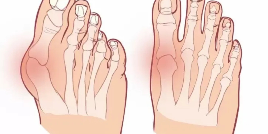 Никаких больше косточек на больших пальцах стоп: 10 правил, которые мне помогли