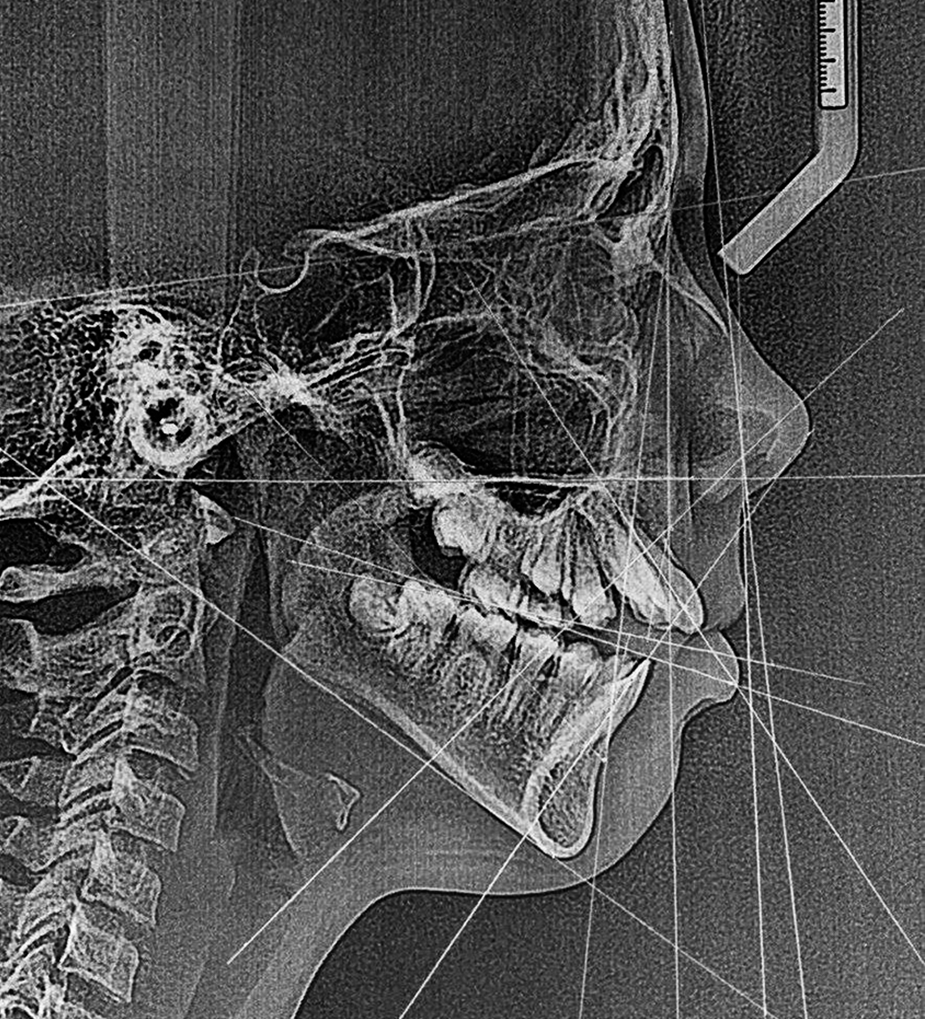 Традиционные цефалометрические анализы - старые диагностические подходы в ортодонтии и челюстно-лицевой хирургии, которые используют нестабильные внутричерепные ориентиры, а данные пациента просто сравнивают с данными "усреднённой" придуманной "нормы".