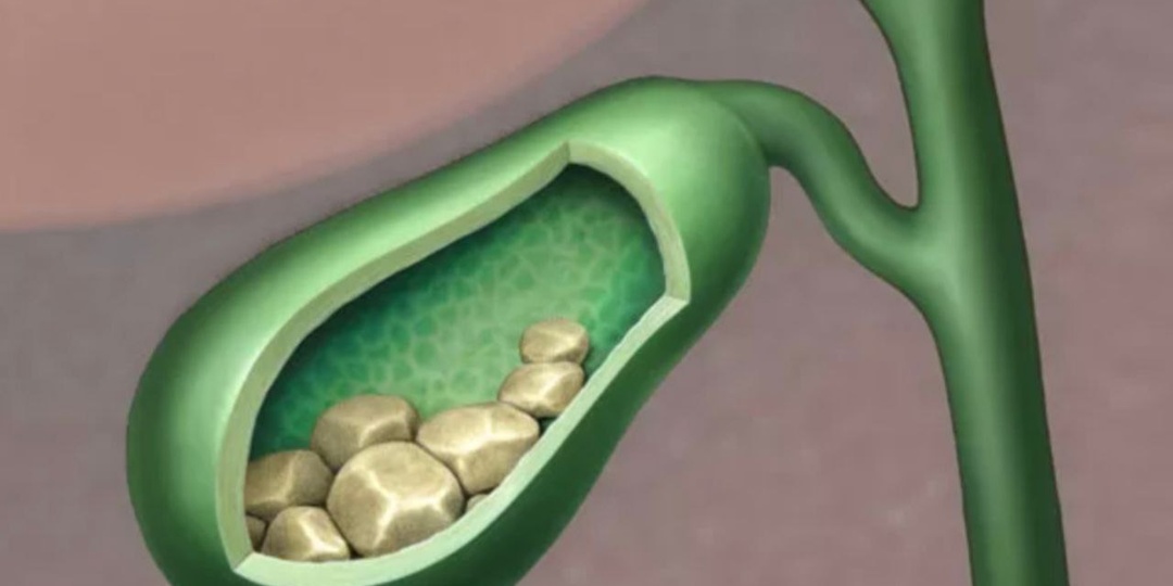 ЖЕЛЧНЫЙ ПУЗЫРЬ БАРАХЛИТ