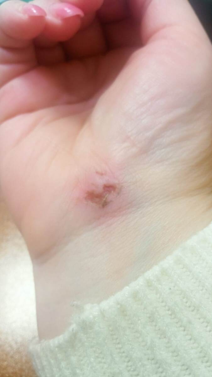 это уже начал заживать..