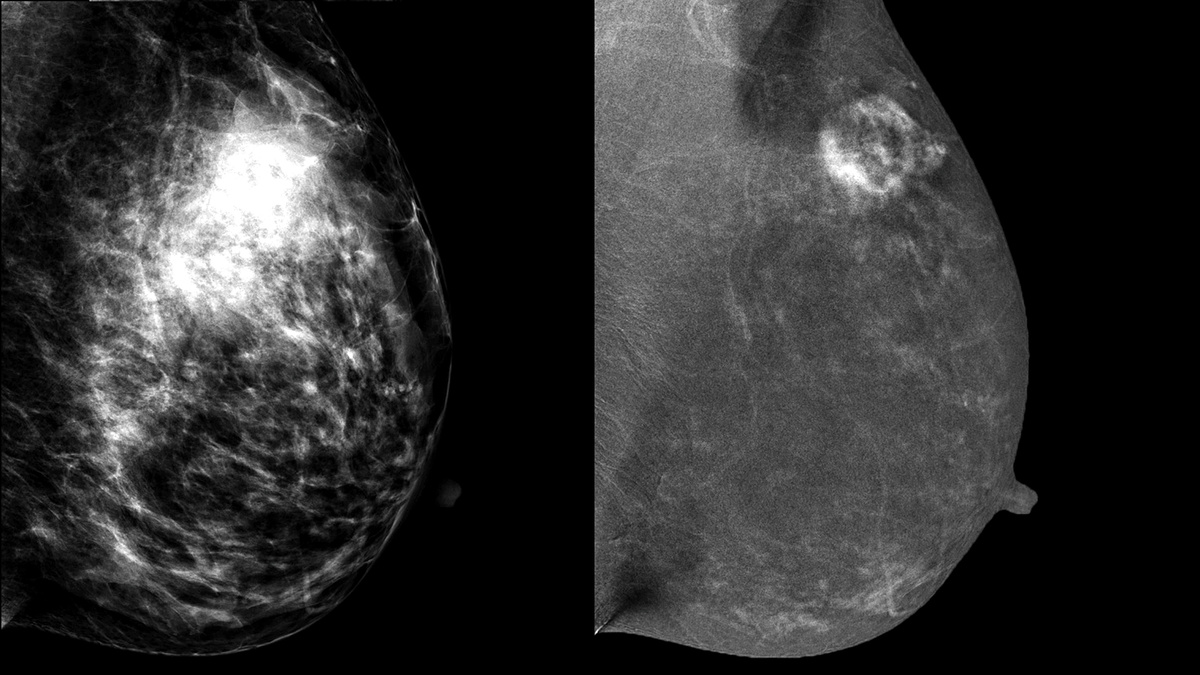 Двуэнергетическая контрастная маммография. Слева "низкоэнергитический" снимок (LM), с очень плотной железистой тканью в верхне-наружном квадранте. Справа объединенный снимок (REI), на котором четко видно образование с неровными толтыми контурами, участками усиления внутри образования. Впоследствии гистологически подтверждена инвазивная протоковая карцинома.  