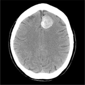 Картинка взята из интернета для представления об опухолевом процессе.