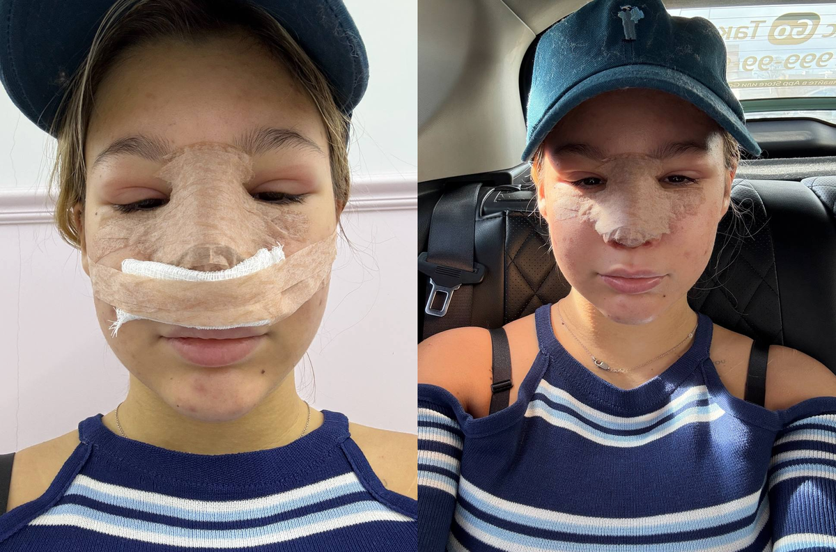 Полина Аксенова после ринопластики. Фото: Telegram / @poxenovaa