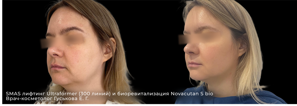 Фотографии ДО и ПОСЛЕ смас лифтинга ультраформер мпт и биоревитализации Новакутан | клиника косметологии GEN87